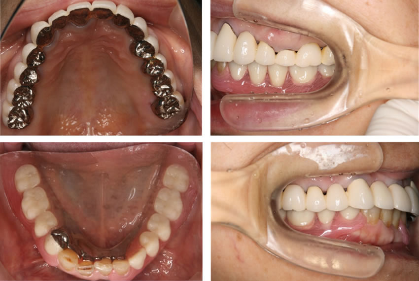 審美歯科：治療終了時　治療に要した時間は1年3ヶ月、ほぼ全ての食べ物を噛むことが出来、人前でも笑えるように。
