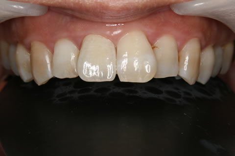 前歯部補綴症例：補修完了　歯茎との調和もとれたきれいな修復ができました。