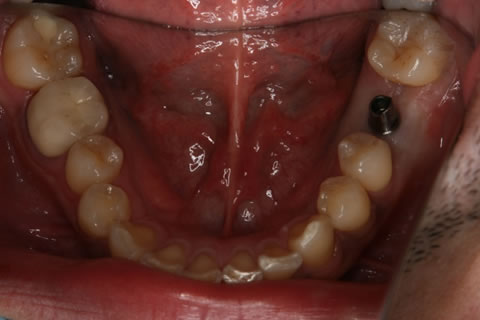 インプラント　５か月目には最終的な人工の歯の土台を立てました。