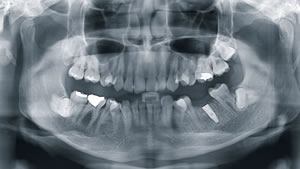 陽歯科クリニック　3DCTの撮影例（京セラUni-3D HPより）